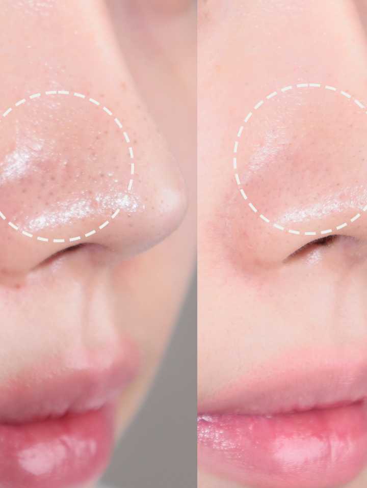 Bye Blackhead Melting Remover (Gözenek ve Siyah Nokta Temizleyici)